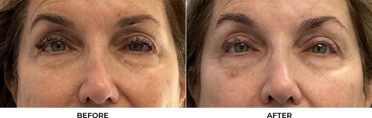 77 year old woman who was bothered by drooping of the upper eyelids. She underwent external ptosis repair. After photos are 3 months post-bilateral external ptosis repair. Results can last 10 years.				