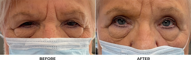 88 year old woman who was bothered by drooping of the upper eyelids. She underwent external ptosis repair and blepharoplasty of the upper eyelids. After photos are 1 month post-bilateral external ptosis repair and blepharoplasty. Results can last 10 years.				