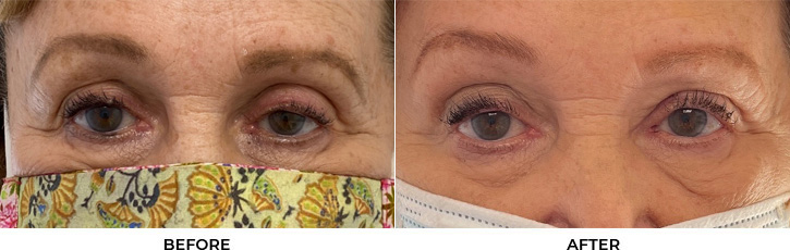 79 year old woman who was bothered by drooping of the left upper eyelid. She underwent left upper eyelid external ptosis repair. After photos are 2 months post-left upper eyelid external ptosis repair. Results can last 10 years.				