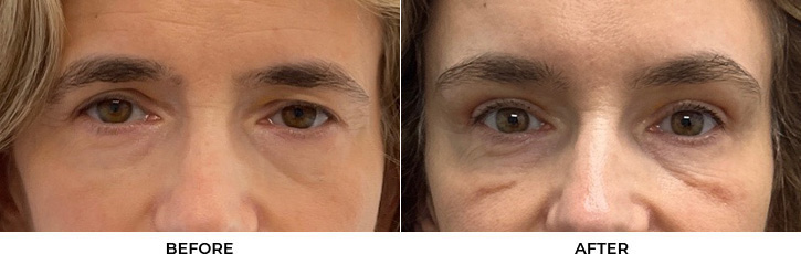 53 year old woman who was bothered by heaviness of upper eyelids. She underwent upper blepharoplasty and endoscopic eyebrow and forehead lifting. After photos are 1 month post-procedure.				