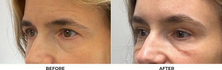 53 year old woman who was bothered by heaviness of upper eyelids. She underwent upper blepharoplasty and endoscopic eyebrow and forehead lifting. After photos are 1 month post-procedure.				