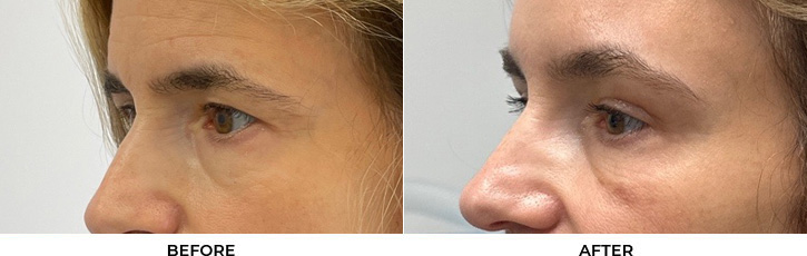 53 year old woman who was bothered by heaviness of upper eyelids. She underwent upper blepharoplasty and endoscopic eyebrow and forehead lifting. After photos are 1 month post-procedure.				
