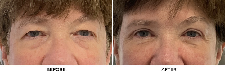 60 year old woman who was bothered by her upper and lower eyelid appearance. She underwent upper and lower eyelid blepharoplasty. After photos are shown at 3 months post-surgery.				