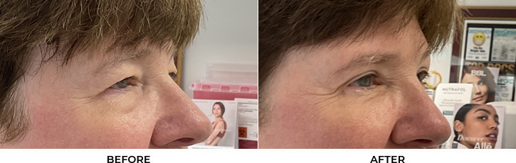 60 year old woman who was bothered by her upper and lower eyelid appearance. She underwent upper and lower eyelid blepharoplasty. After photos are shown at 3 months post-surgery.				