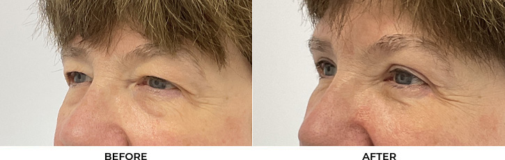 60 year old woman who was bothered by her upper and lower eyelid appearance. She underwent upper and lower eyelid blepharoplasty. After photos are shown at 3 months post-surgery.				