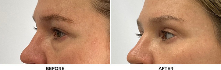 43 year old woman who was bothered by her upper and lower eyelid appearance. She underwent upper and lower eyelid blepharoplasty with periocular CO2. After results are shown at 3 months post-surgery.				