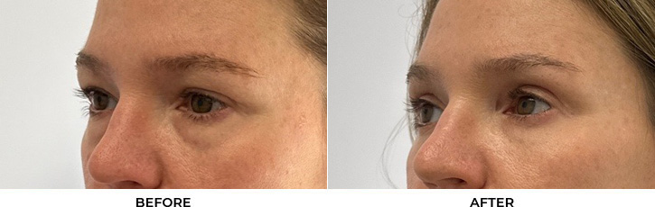 43 year old woman who was bothered by her upper and lower eyelid appearance. She underwent upper and lower eyelid blepharoplasty with periocular CO2. After results are shown at 3 months post-surgery.				