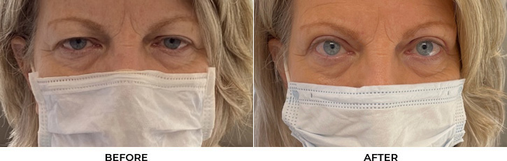 60 year old woman who was bothered by her upper eyelid appearance. She underwent upper eyelid blepharoplasty. After photos show results at 3 months post-surgery.				