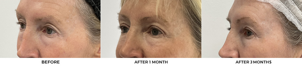 64 year old woman who was bothered by her upper eyelid appearance. She underwent upper eyelid blepharoplasty and Morpheus8 treatment. After photos show results at 1 month and 3 months post-surgery.				
