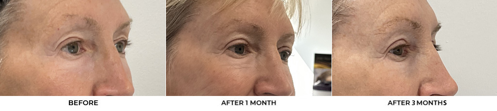 64 year old woman who was bothered by her upper eyelid appearance. She underwent upper eyelid blepharoplasty and Morpheus8 treatment. After photos show results at 1 month and 3 months post-surgery.				