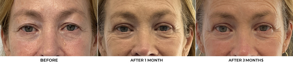 66 year old woman who was bothered by her upper eyelid appearance. She underwent upper eyelid blepharoplasty and internal browpexy. After photos show results at 1 month and 3 months post-surgery.				