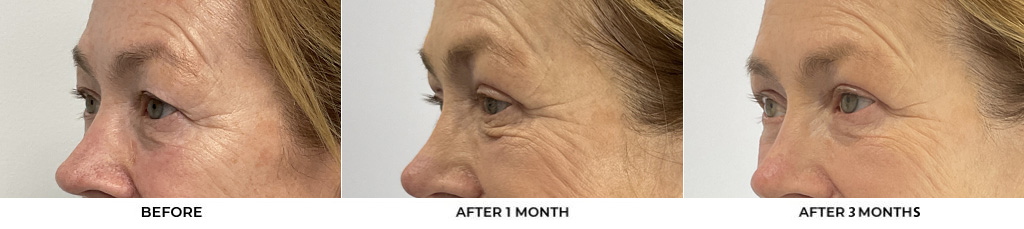 66 year old woman who was bothered by her upper eyelid appearance. She underwent upper eyelid blepharoplasty and internal browpexy. After photos show results at 1 month and 3 months post-surgery.				