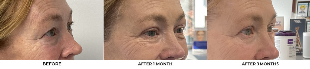 66 year old woman who was bothered by her upper eyelid appearance. She underwent upper eyelid blepharoplasty and internal browpexy. After photos show results at 1 month and 3 months post-surgery.				
