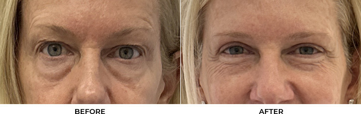 60 year old woman who was bothered by her upper eyelid appearance. She underwent upper eyelid blepharoplasty and internal browpexy. After photos show results at 3 months post-surgery.				