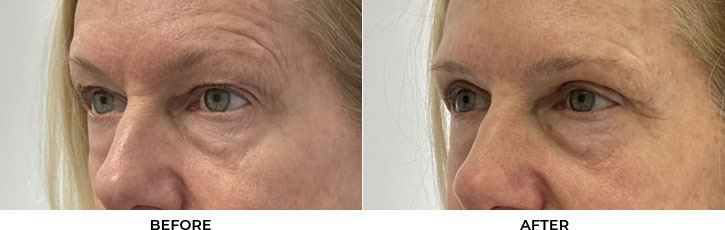 60 year old woman who was bothered by her upper eyelid appearance. She underwent upper eyelid blepharoplasty and internal browpexy. After photos show results at 3 months post-surgery.				