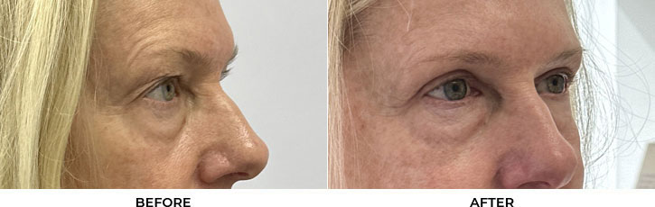 60 year old woman who was bothered by her upper eyelid appearance. She underwent upper eyelid blepharoplasty and internal browpexy. After photos show results at 3 months post-surgery.				
