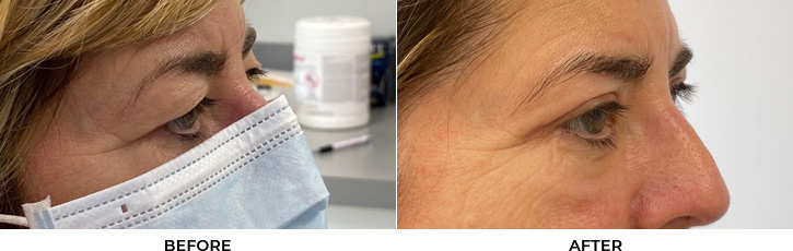 64 year old woman who was bothered by her upper eyelid appearance. She underwent upper eyelid blepharoplasty. After photos show results at 1 month post-surgery.				