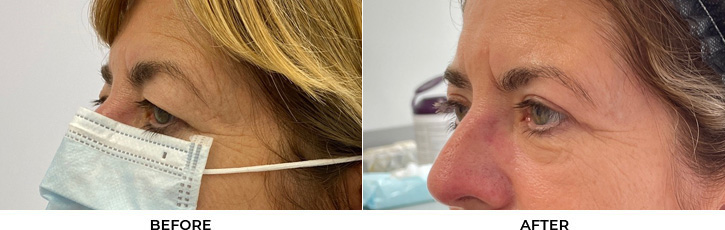 64 year old woman who was bothered by her upper eyelid appearance. She underwent upper eyelid blepharoplasty. After photos show results at 1 month post-surgery.				