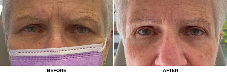 72 year old woman who was bothered by her upper eyelid appearance. She underwent upper eyelid blepharoplasty and internal browpexy. After photos show results at 3 months post-surgery.				