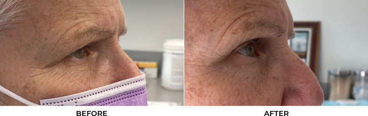 72 year old woman who was bothered by her upper eyelid appearance. She underwent upper eyelid blepharoplasty and internal browpexy. After photos show results at 3 months post-surgery.				