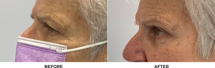 72 year old woman who was bothered by her upper eyelid appearance. She underwent upper eyelid blepharoplasty and internal browpexy. After photos show results at 3 months post-surgery.				