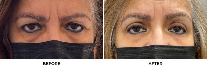 65 year old woman who was bothered by her upper eyelid appearance. She underwent upper eyelid blepharoplasty and internal browpexy. After photos show results at 3 months post-surgery.				