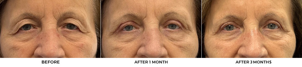 76 year old woman who was bothered by her upper eyelid appearance. She underwent upper eyelid blepharoplasty and internal browpexy. After photos show results at 3 months post-surgery				