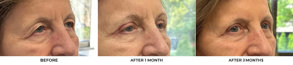76 year old woman who was bothered by her upper eyelid appearance. She underwent upper eyelid blepharoplasty and internal browpexy. After photos show results at 3 months post-surgery				
