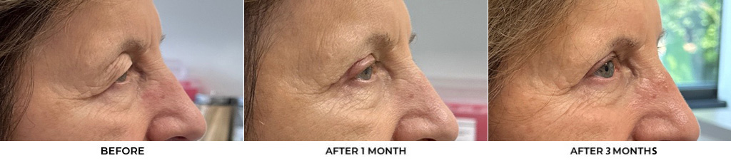 76 year old woman who was bothered by her upper eyelid appearance. She underwent upper eyelid blepharoplasty and internal browpexy. After photos show results at 3 months post-surgery				