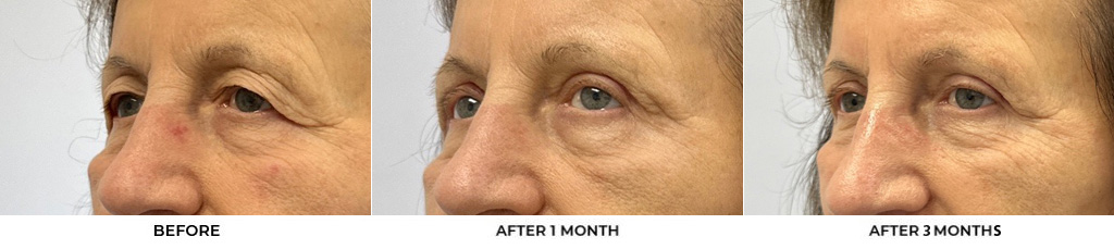 76 year old woman who was bothered by her upper eyelid appearance. She underwent upper eyelid blepharoplasty and internal browpexy. After photos show results at 3 months post-surgery				