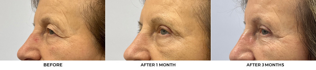 76 year old woman who was bothered by her upper eyelid appearance. She underwent upper eyelid blepharoplasty and internal browpexy. After photos show results at 3 months post-surgery				