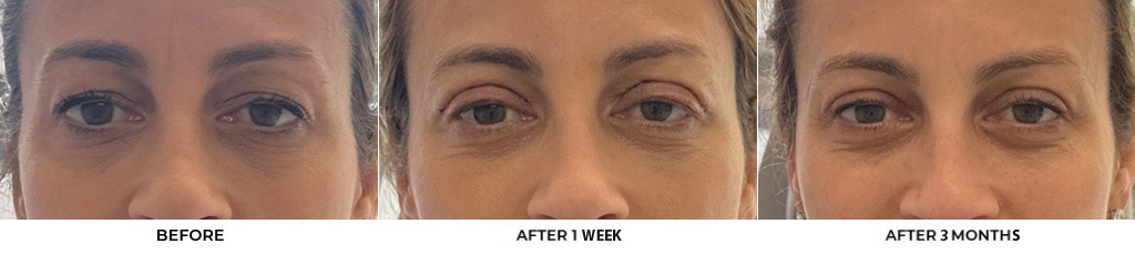 48 year old woman who was bothered by her upper eyelid appearance. She underwent upper eyelid blepharoplasty. After photos show results at 1 week and 3 months post-surgery				