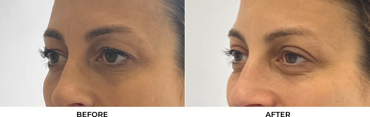 48 year old woman who was bothered by her upper eyelid appearance. She underwent upper eyelid blepharoplasty. After photos show results at 1 week and 3 months post-surgery				
