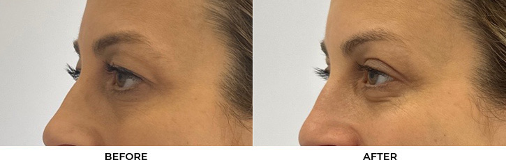 48 year old woman who was bothered by her upper eyelid appearance. She underwent upper eyelid blepharoplasty. After photos show results at 1 week and 3 months post-surgery				