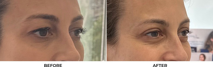 48 year old woman who was bothered by her upper eyelid appearance. She underwent upper eyelid blepharoplasty. After photos show results at 1 week and 3 months post-surgery				