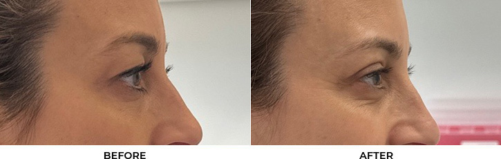 48 year old woman who was bothered by her upper eyelid appearance. She underwent upper eyelid blepharoplasty. After photos show results at 1 week and 3 months post-surgery				