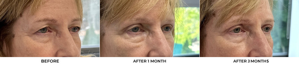 69 year old woman who was bothered by her upper eyelid appearance. She underwent upper eyelid blepharoplasty and internal browpexy. After photos show results at 1 month and 3 months after surgery				