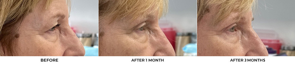 69 year old woman who was bothered by her upper eyelid appearance. She underwent upper eyelid blepharoplasty and internal browpexy. After photos show results at 1 month and 3 months after surgery				