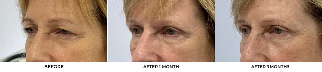 69 year old woman who was bothered by her upper eyelid appearance. She underwent upper eyelid blepharoplasty and internal browpexy. After photos show results at 1 month and 3 months after surgery				
