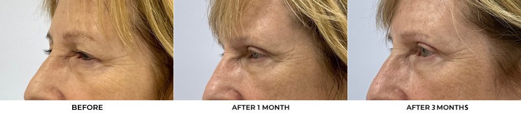 69 year old woman who was bothered by her upper eyelid appearance. She underwent upper eyelid blepharoplasty and internal browpexy. After photos show results at 1 month and 3 months after surgery				