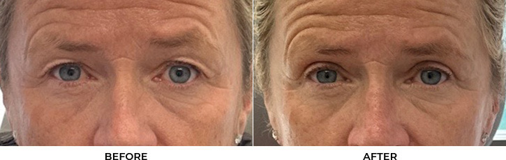 55 year old woman who was bothered by her upper eyelid appearance. She underwent upper eyelid blepharoplasty. After photos show results at 1 month and 3 months after surgery.				