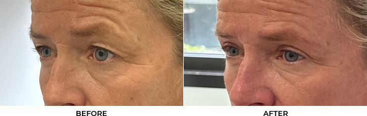 55 year old woman who was bothered by her upper eyelid appearance. She underwent upper eyelid blepharoplasty. After photos show results at 1 month and 3 months after surgery.				