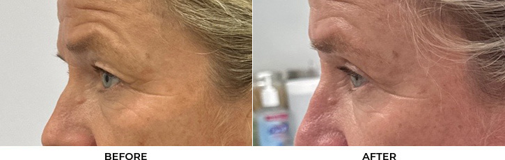 55 year old woman who was bothered by her upper eyelid appearance. She underwent upper eyelid blepharoplasty. After photos show results at 1 month and 3 months after surgery.				