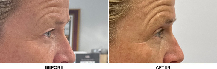 55 year old woman who was bothered by her upper eyelid appearance. She underwent upper eyelid blepharoplasty. After photos show results at 1 month and 3 months after surgery.				