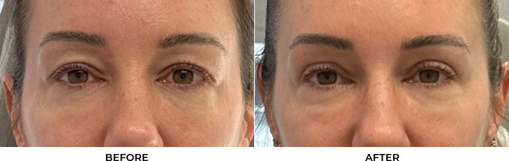 45 year old woman who was bothered by her upper eyelid appearance. She underwent upper eyelid blepharoplasty. After photos show results at 3 months after surgery.				