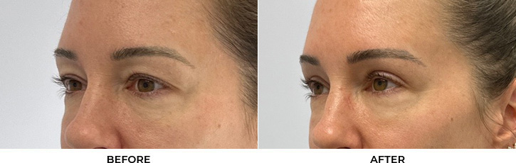 45 year old woman who was bothered by her upper eyelid appearance. She underwent upper eyelid blepharoplasty. After photos show results at 3 months after surgery.				