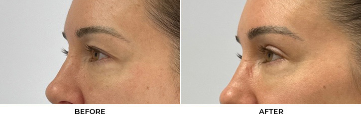 45 year old woman who was bothered by her upper eyelid appearance. She underwent upper eyelid blepharoplasty. After photos show results at 3 months after surgery.				