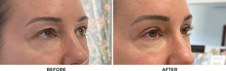 45 year old woman who was bothered by her upper eyelid appearance. She underwent upper eyelid blepharoplasty. After photos show results at 3 months after surgery.				
