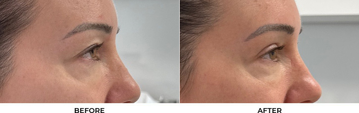 45 year old woman who was bothered by her upper eyelid appearance. She underwent upper eyelid blepharoplasty. After photos show results at 3 months after surgery.				
