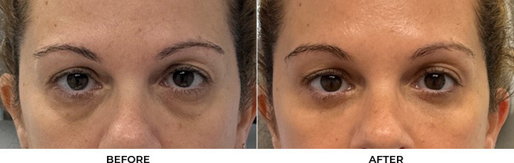 51 year old woman who was bothered by the appearance of her lower eyelids. She underwent transconjunctival lower eyelid blepharoplasty with fat transposition, skin pinch, and CO2 resurfacing. After photos were obtained 6 months post-procedure. Results can last 10 years.				